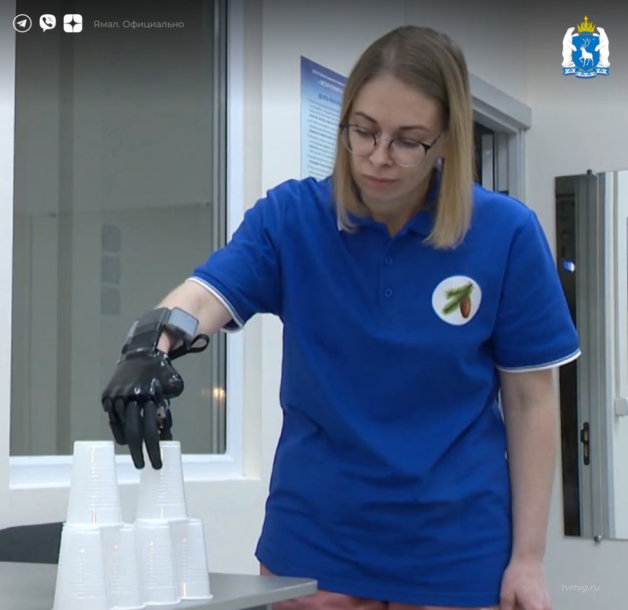 На Ямале впервые изготовили для пациента бионический протез руки